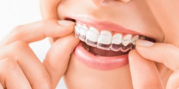 Aligner Zahnschiene - Zahnarztpraxis Friedrichshafen Dr. Schwarzott