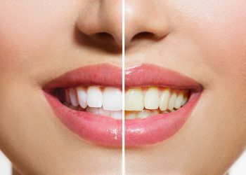 Zahnbleaching | Zahnarztpraxis Dr. Schwarzott