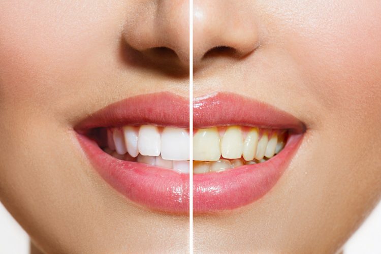 Zahnbleaching | Zahnarztpraxis Dr. Schwarzott
