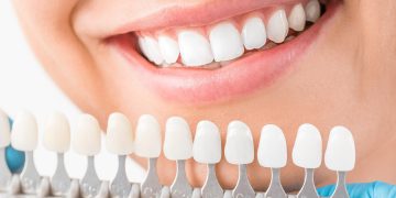 veneers - Zahnarzt Friedrichshafen Dr. Schwarzott