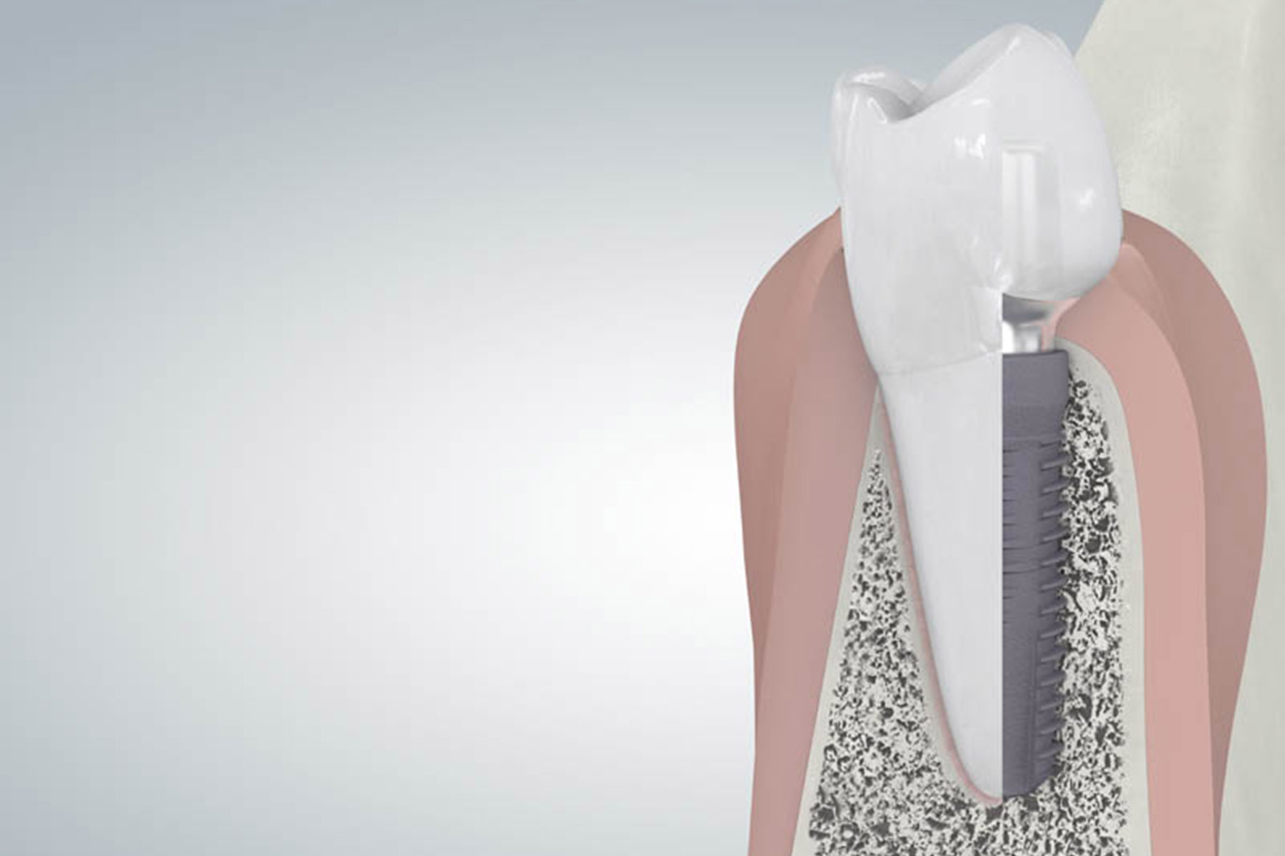 zahnersatz | Zahnarztpraxis Dr. Schwarzott