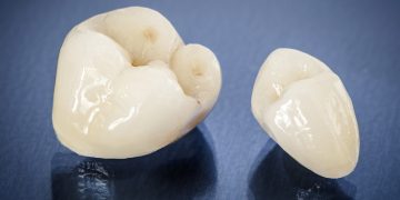 Zahnkrone - Zahnarztpraxis Friedrichshafen Dr. Schwarzott